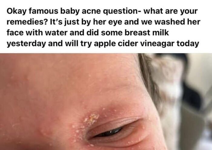 A close-up of a baby's eye with what appears to be acne, from unhinged people sharing thoughts on social media.