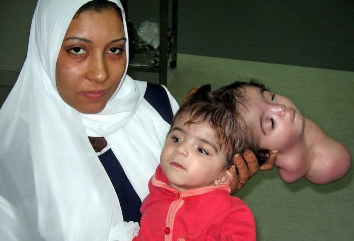 Child with rare physical condition and mother beside