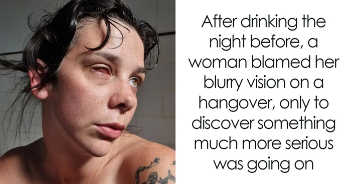 Woman Thinks Her Blurry Vision Is Just A Hangover, Ends Up Losing Her Eye After Doctors Find A Tumor