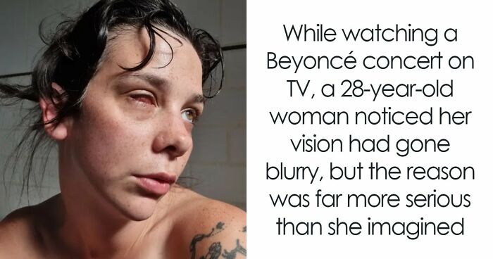 Woman Thinks Her Blurry Vision Is Just A Hangover, Ends Up Losing Her Eye After Doctors Find A Tumor