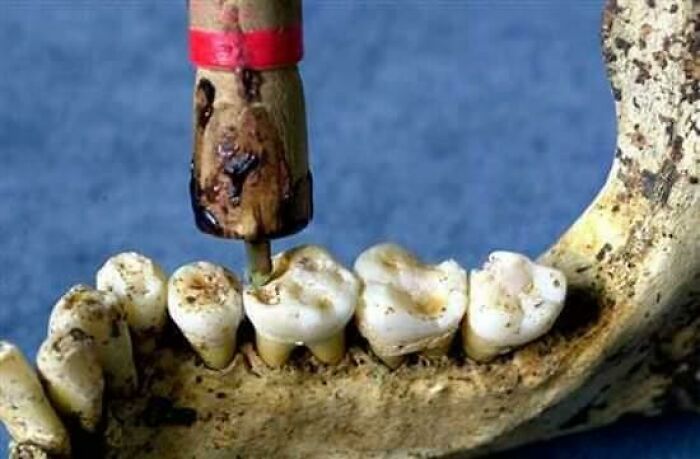 Close-up of a primitive dental tool drill inside an ancient jaw bone from medical history.