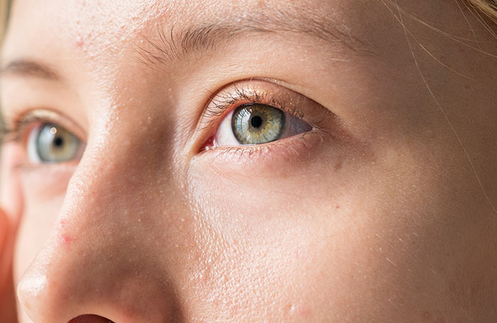 Close-up of facial skin showing white spots near eye