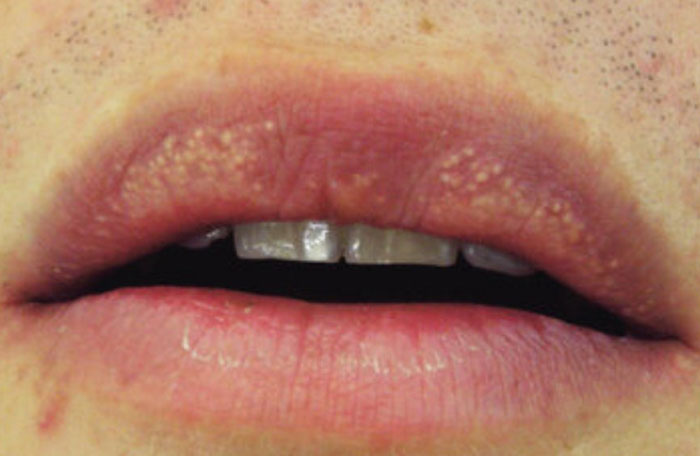 Close-up of lips with clusters of white spots visible