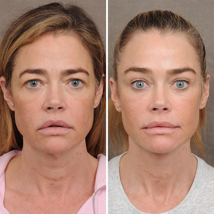Denise Richards’ $200K Facelift Fuels ‘The Substance’ Comparisons As Before-And-After Photos Go Viral Denise Richards’ $200K Facelift Fuels ‘The Substance’ Comparisons As Before-And-After Photos Go Viral