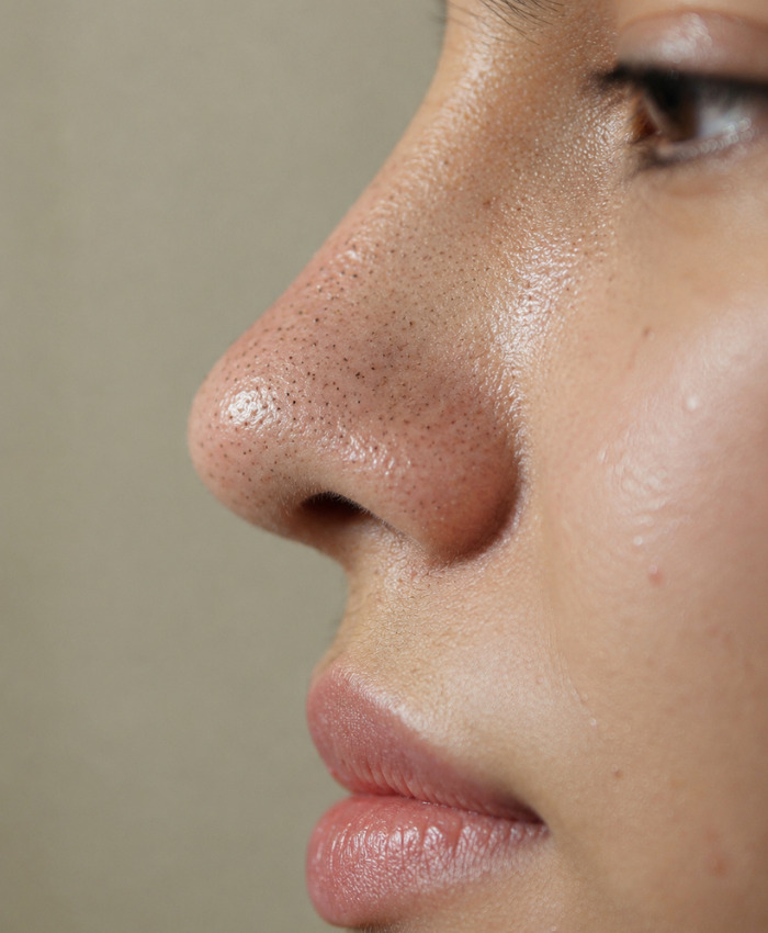 Side profile view of a nose covered in small black spots Side profile view of a nose covered in small black spots