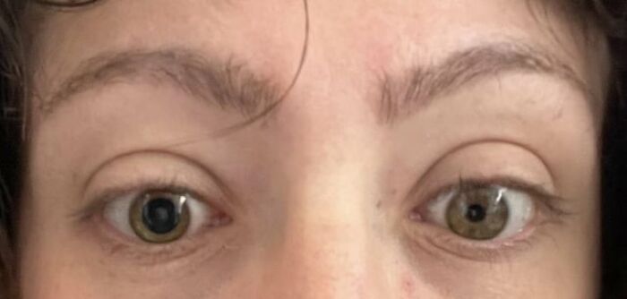 A creepy photo close-up of a person eyes showing pupils of completely different sizes.