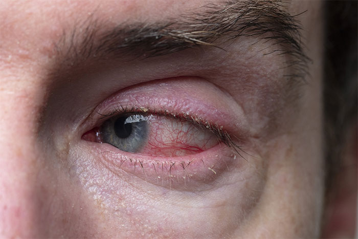 Close-up of eye with redness and irritation from eye rubbing Close-up of eye with redness and irritation from eye rubbing