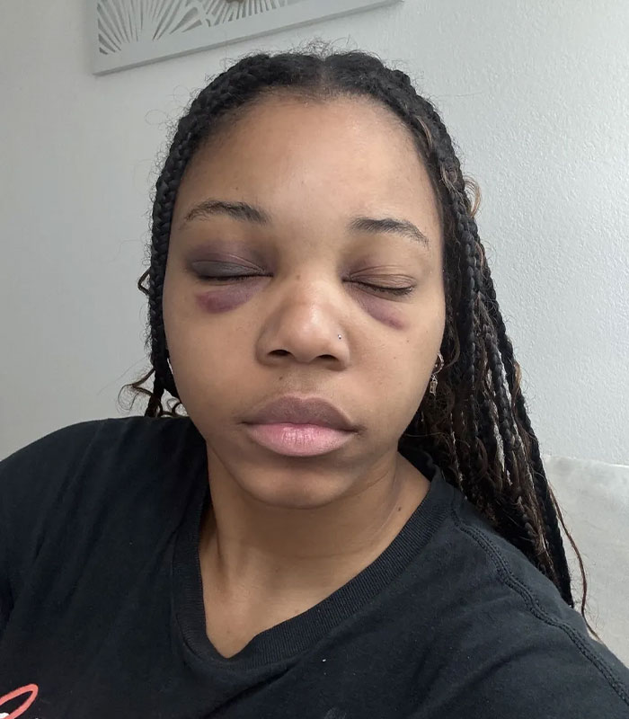 Close-up of Arizona State Cheerleader showing facial bruises and black eyes