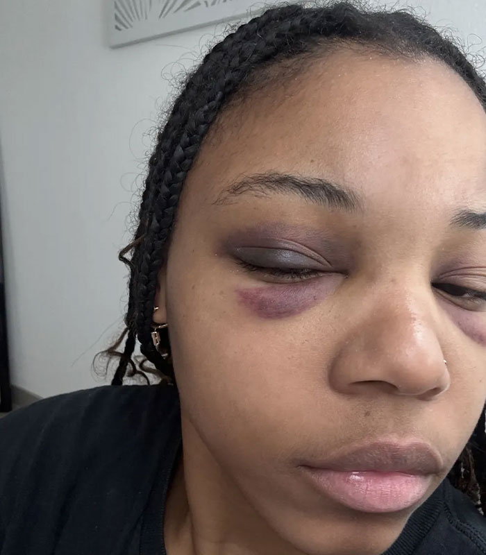 Close-up of Arizona State cheerleader showing facial injuries from being thrown to the ground.