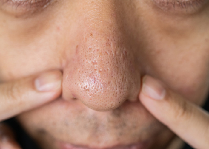 Close-up of fingers squeezing a nose covered in black spots Close-up of fingers squeezing a nose covered in black spots