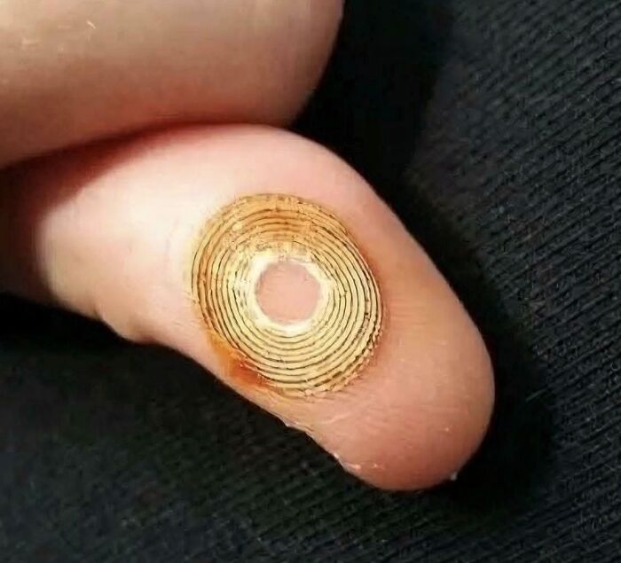 Close-up of a circular wart on a person's finger with concentric rings