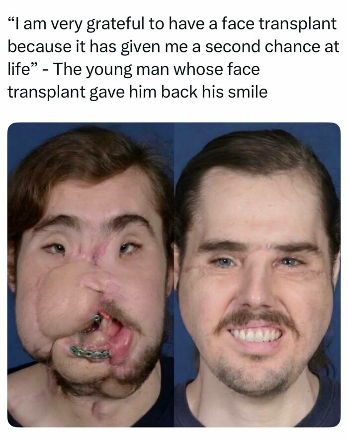 Before and after face transplant comparison of a young man, a remarkable story about the world around us.