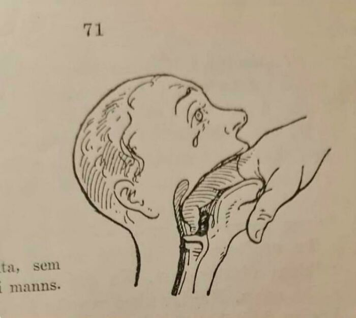 Historical medical illustration showing a rare technique in swallowing or throat anatomy