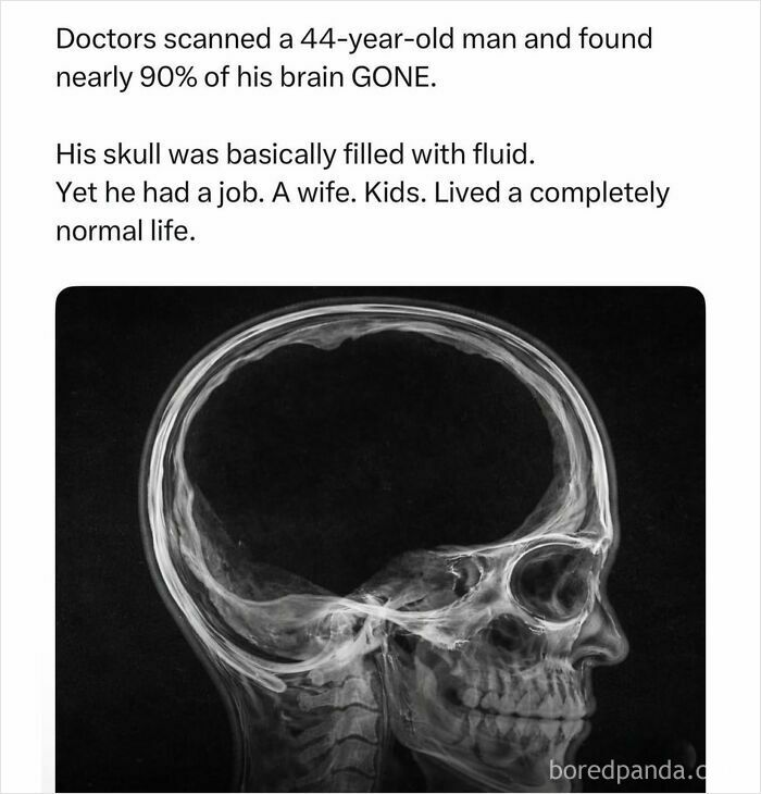 X-ray of a skull with nearly 90 percent brain missing boys just livin posts