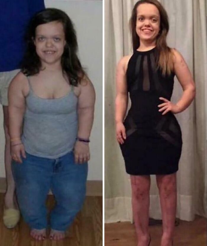 The Photo Features Chandler Crews, A Woman With Achondroplasia, A Form Of Dwarfism