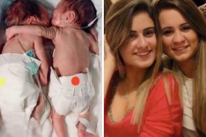 In 1995, This Premature Twin Was Dying Until A Nurse Broke Protocol And Placed Her In The Same Incubator As Her Sister. The Hug Saved Her Life
