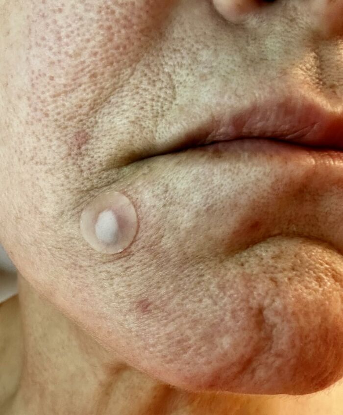 A small round acne patch on a person's chin, showcasing trending items on Amazon.