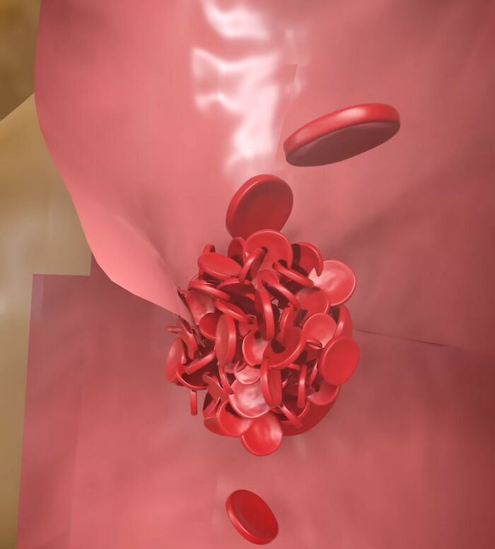 Doc Shares Graphic Simulation Of Neck Cracking, Revealing How A Simple Twist Could Lead To A Stroke
