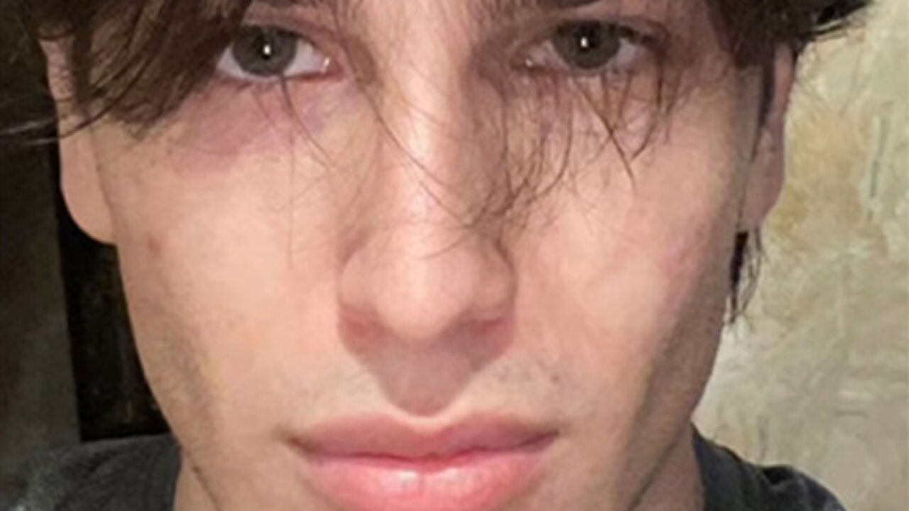 From Botox To $35,000 Jaw Surgery: The Extreme Procedures Promoted At A Looksmaxxing Camp