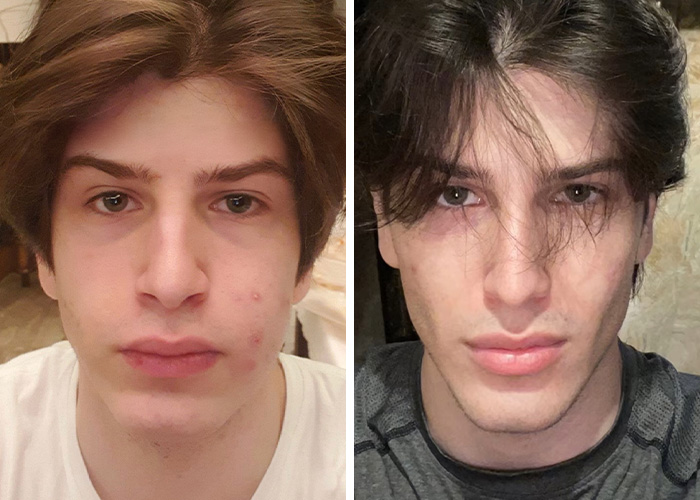 Before and after facial transformation showing jaw surgery results from looksmaxxing. Before and after facial transformation showing jaw surgery results from looksmaxxing.