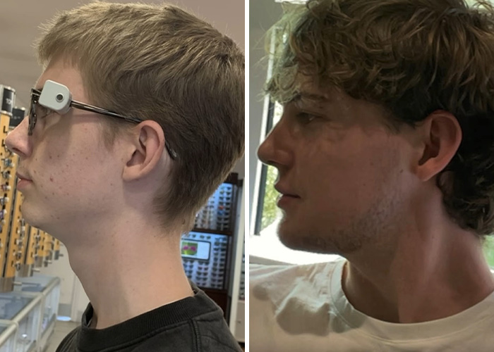 Before and after profile views of a man undergoing jaw surgery for looksmaxxing. Before and after profile views of a man undergoing jaw surgery for looksmaxxing.
