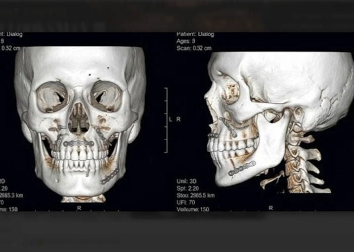 Medical 3D CT scan of a skull showing surgical implants from jaw surgery. Medical 3D CT scan of a skull showing surgical implants from jaw surgery.