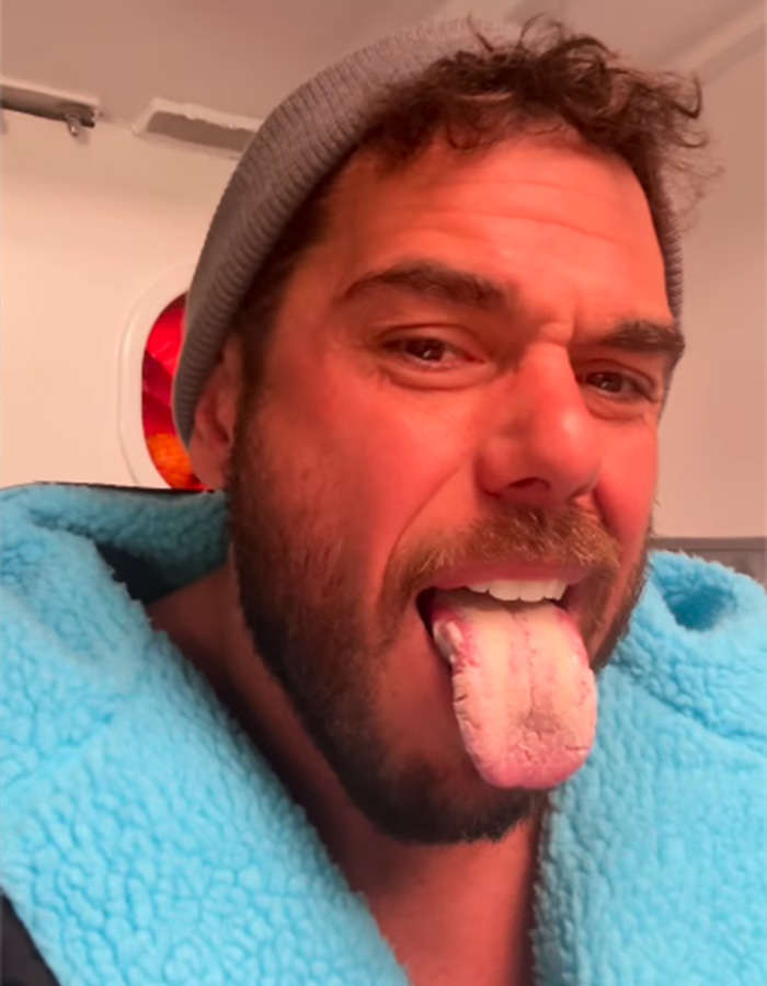 Extreme swimmer showing his swollen and discolored tongue caused by salt water exposure during an ocean swim Extreme swimmer showing his swollen and discolored tongue caused by salt water exposure during an ocean swim