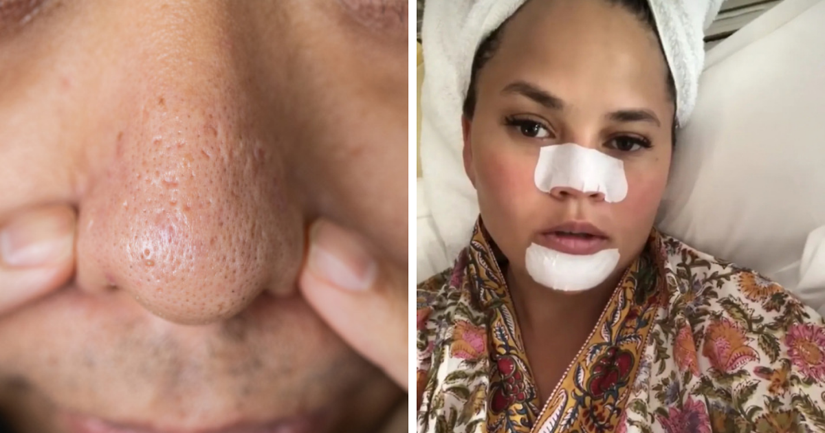 Dermatologist Warns Squeezing Black Spots On Your Nose Is A Serious Mistake Because They’re Not What You Think