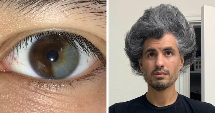 66 Cool Pics Of Unusual Body Traits And Conditions People Have