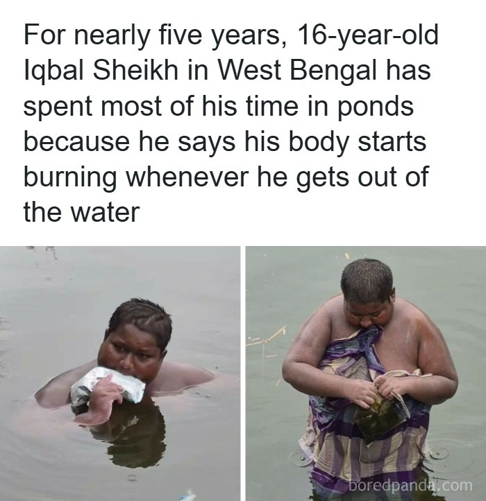 A teenage boy standing in water because his body burns when he gets out