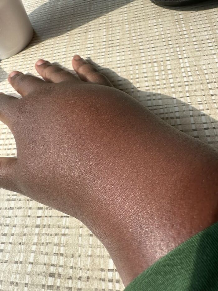 A severely swollen hand resting on a table, shown in creepy photos of unusual injuries