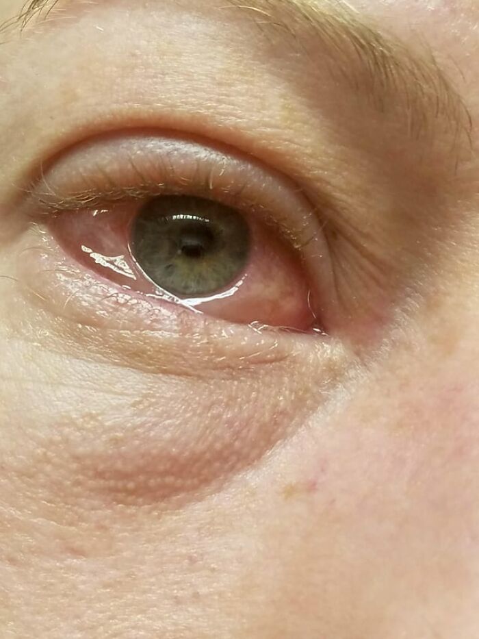 An extreme closeup of an irritated eye showing a double pupil, creating a weird and creepy photo.