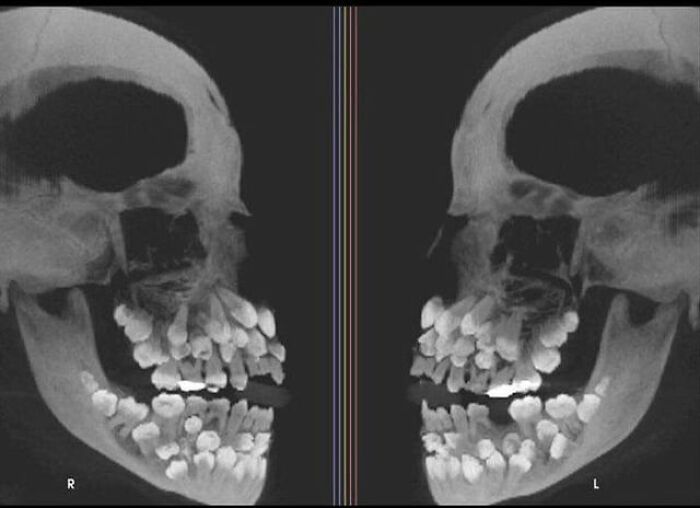 A weird and creepy X-ray photo showing a human skull packed with an excessive amount of teeth.