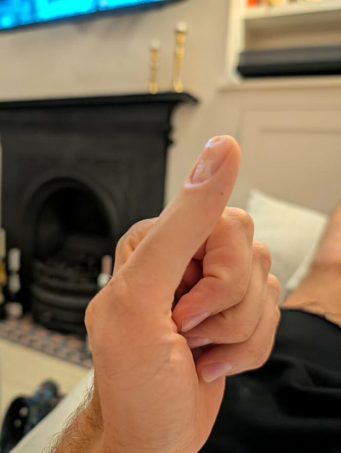 A slightly creepy close-up of a human hand showing an unusually shaped, rounded thumb.