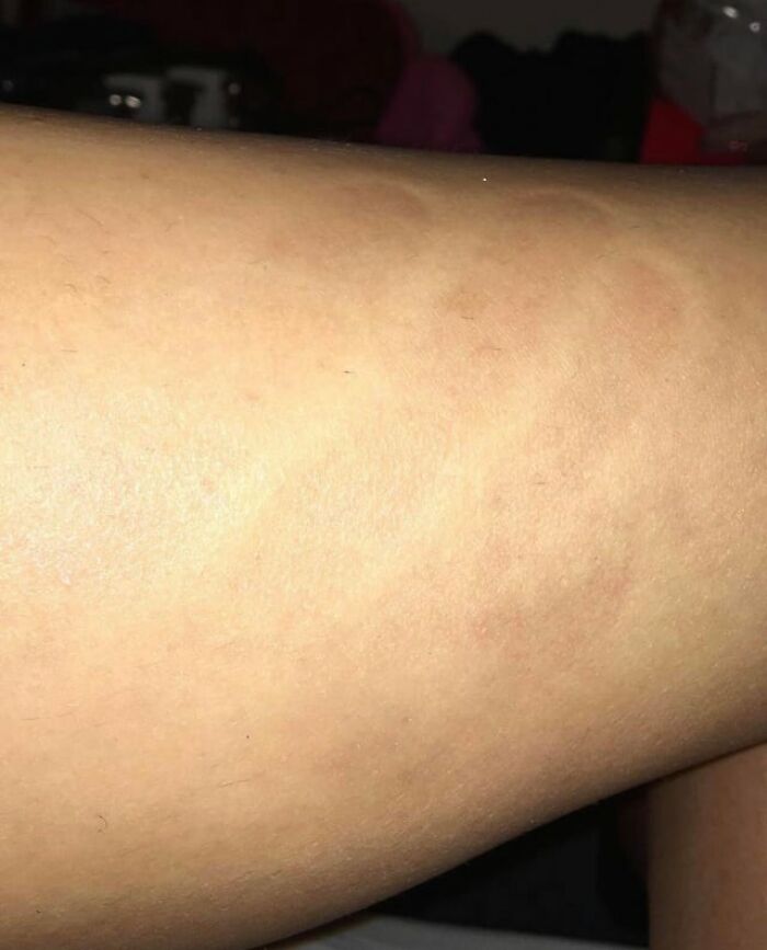 A close up view of skin showing faint marks, counted among creepy photos.