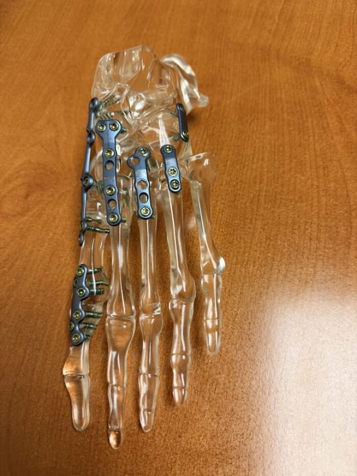 Weird photos showing a transparent foot model with metal plates and screws.
