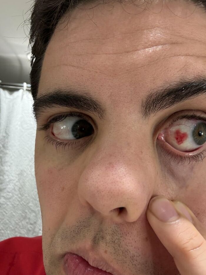 Creepy photos of a person showing a heart shaped red spot inside their eye.