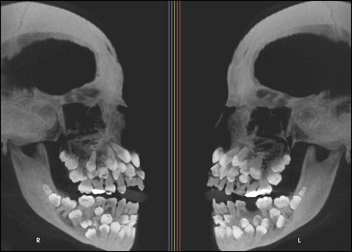 A medical scan of a skull with hyperdontia showing multiple extra teeth, a highlight of interesting and cool pics