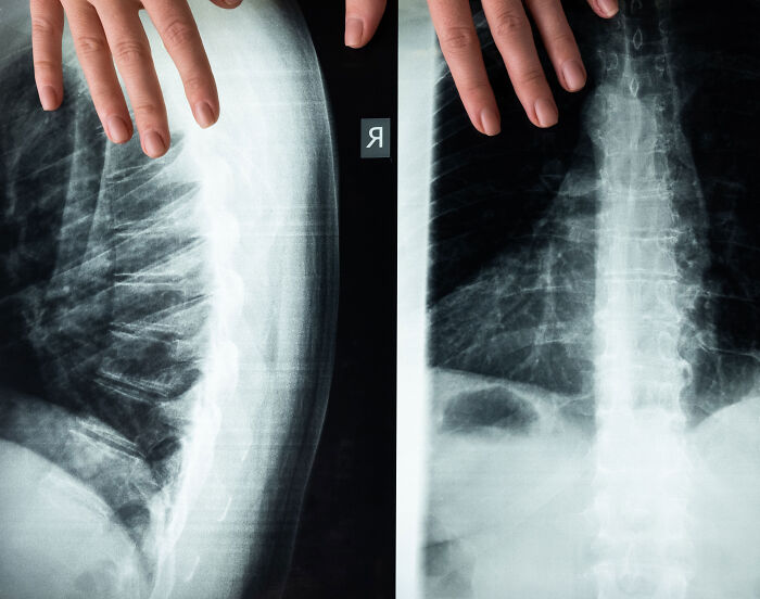 An X-ray scan showing a close-up view of a person's chest and broken ribs