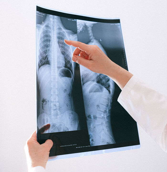 Medical professional examining an X-ray film showing broken ribs after a husband breaks 5 of wife's ribs from a hug.