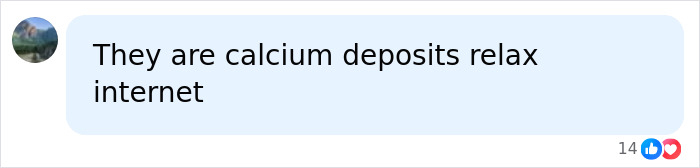 Comment stating clusters of white spots are calcium deposits