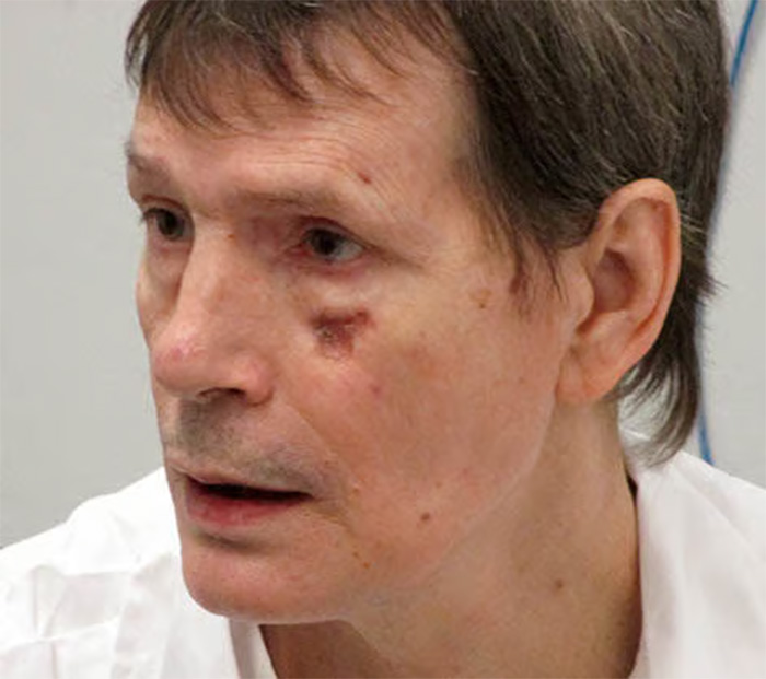Close-up of a man with facial scars, one of the survivors of lethal injection.