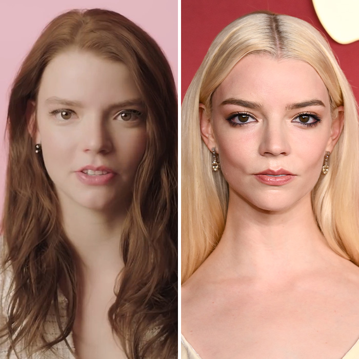Side-by-side comparison of Anya Taylor-Joy showing facial plastic surgery trends over time. Side-by-side comparison of Anya Taylor-Joy showing facial plastic surgery trends over time.