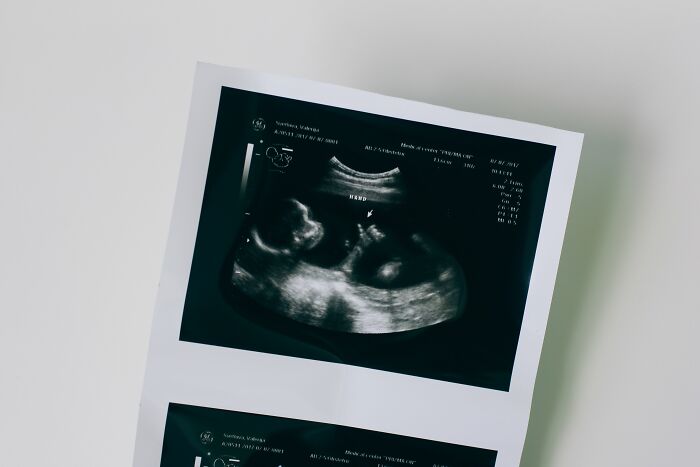 An ultrasound scan showing a developing fetus, representing early human body facts during pregnancy.