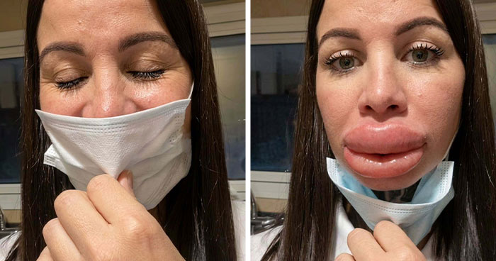 Woman Shares Shocking Lip Filler Results After A Cosmetic Injection Leaves Her In Tears