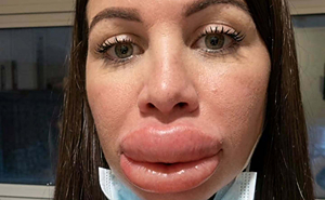 Woman Shares Shocking Lip Filler Results After A Cosmetic Injection Leaves Her In Tears
