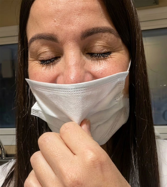 Woman pulling down her face mask before showing severe lip filler swelling results Woman pulling down her face mask before showing severe lip filler swelling results