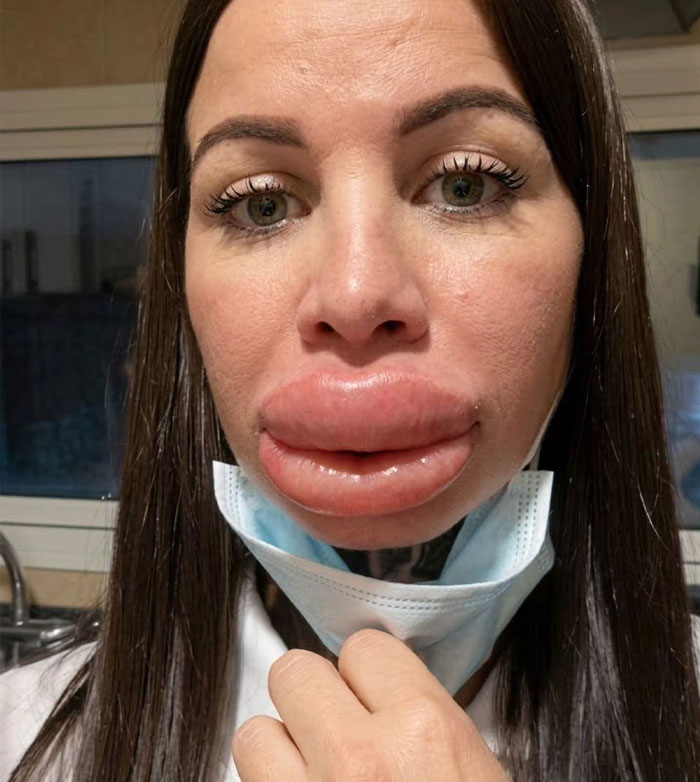 Woman with extremely swollen lips showing severe lip filler complications after a cosmetic injection Woman with extremely swollen lips showing severe lip filler complications after a cosmetic injection